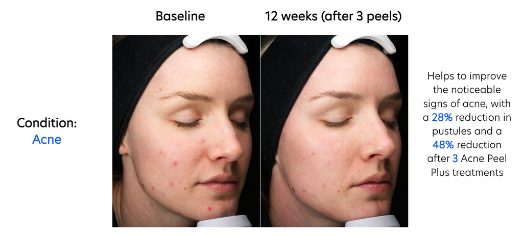 Acne Peel Plus