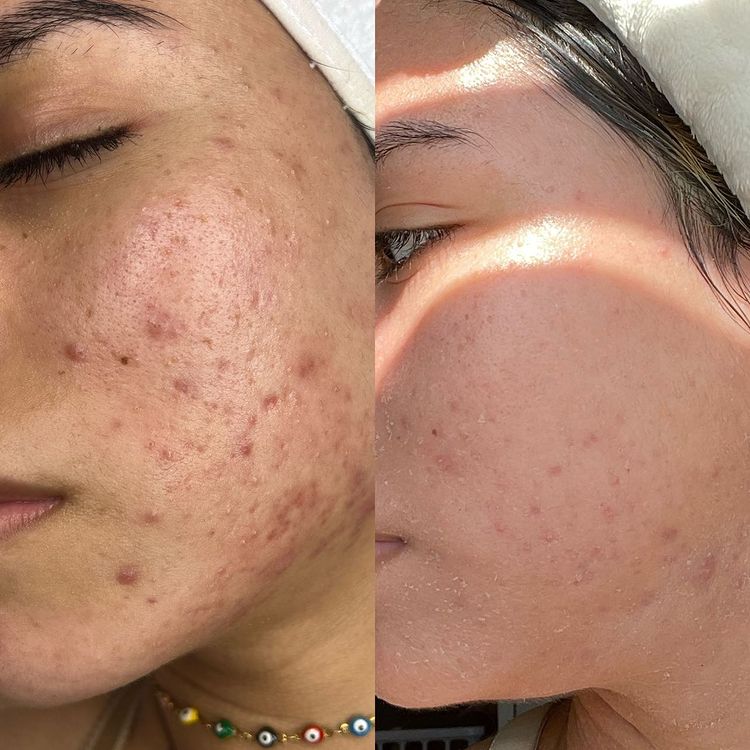 Chemical Peels